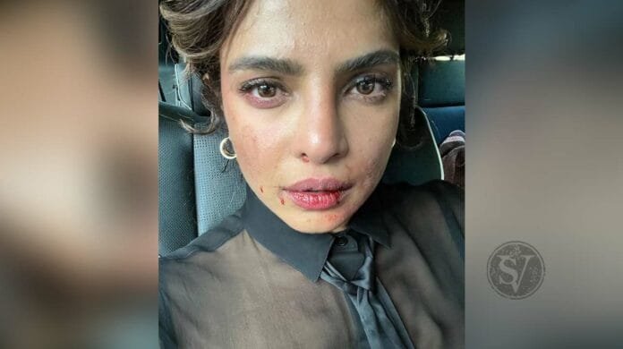 Priyanka shared bruised face