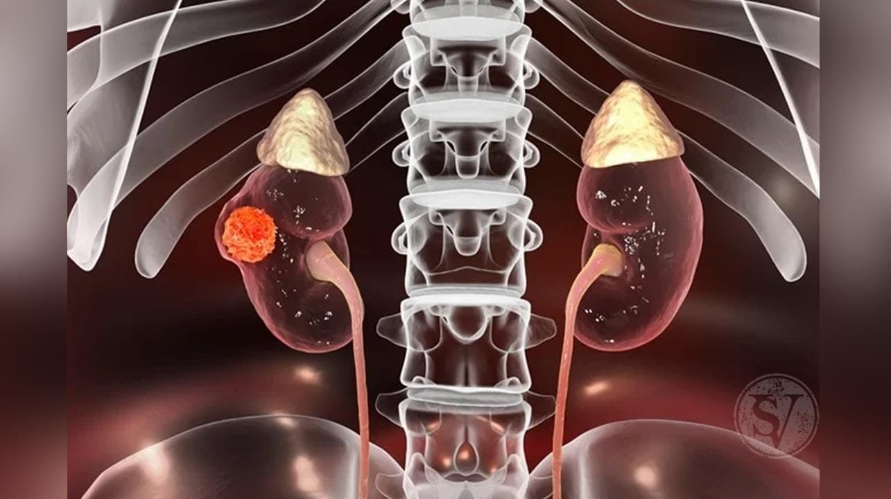 kidney-cancer