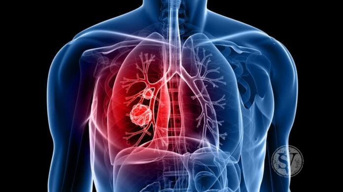 Lung Cancer Symptoms