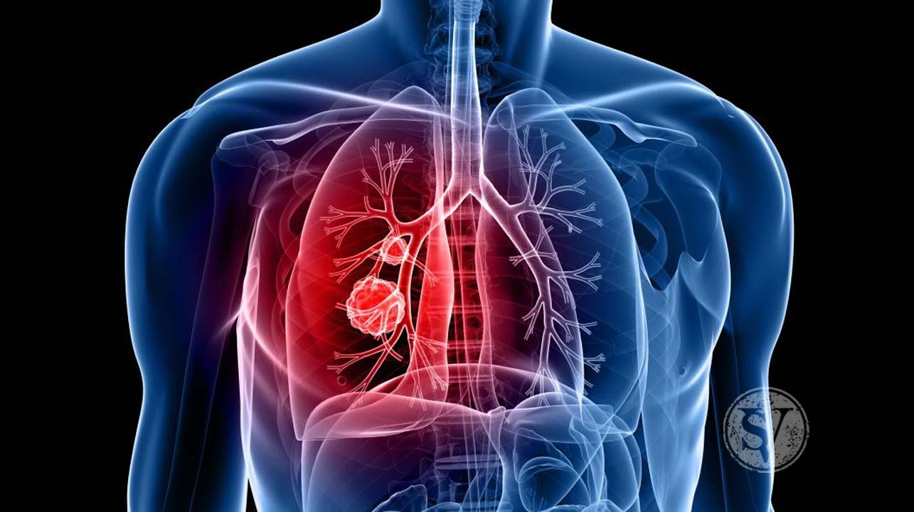 Lung Cancer Symptoms