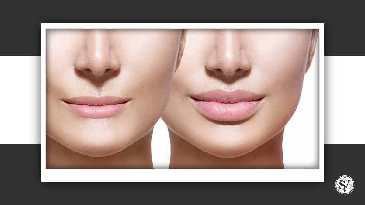 Lip Filler