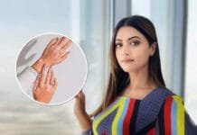 Mamta Mohandas Diagnosis Reveals Actress Suffering From Vitiligo Mamta Mohandas